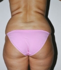 Feel Beautiful - Liposuction Case 9 - Before Photo